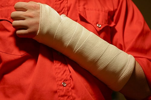 arm in cast